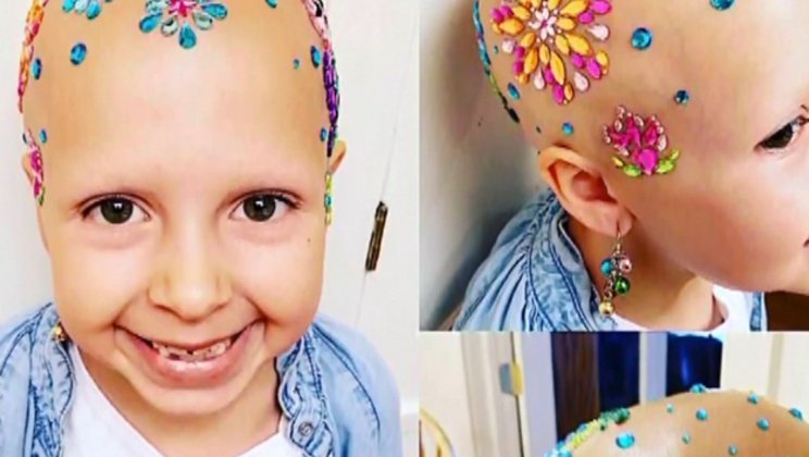Girl with alopecia wins competition with gorgeous jeweled head bit.ly/2oTqRCc https://t.co/4umDZTzIdl