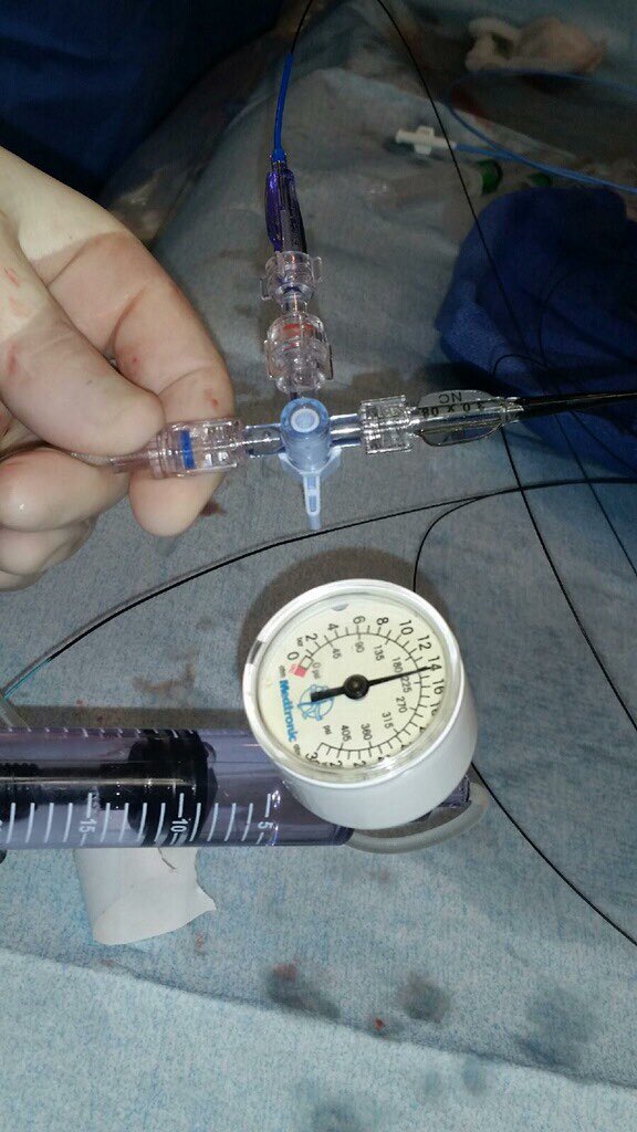 Prashant Kaul (@kaulp) on Twitter photo 2 balloons, 1 indeflator for simultaneous inflations. Picture courtesy <a href="/DrMauricioCohen/">Mauricio G. Cohen MD</a> #CathLabHacks 2 balloons, 1 indeflator for simultaneous inflations. Picture courtesy <a href="/DrMauricioCohen/">Mauricio G. Cohen MD</a> #CathLabHacks