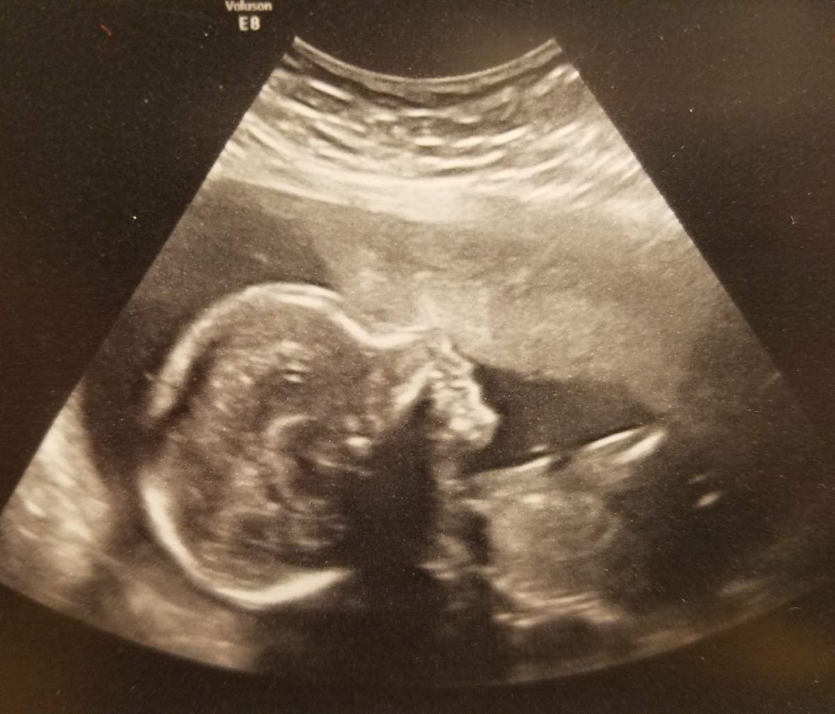 eatrightroc's tweet photo. #rainbowbaby due August 2017! Just trying to keep stress low and life happy. Sorry for being MIA folks! https://t.co/6f7wVyWIoJ