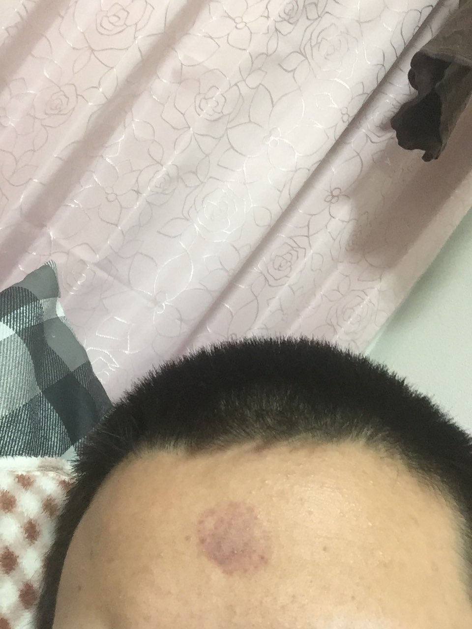 Shotaro おもちゃの吸盤引っ付けたらたむしみたいなんできた笑 うでわほんもののタムシ笑 T Co Q91iqch7et Twitter