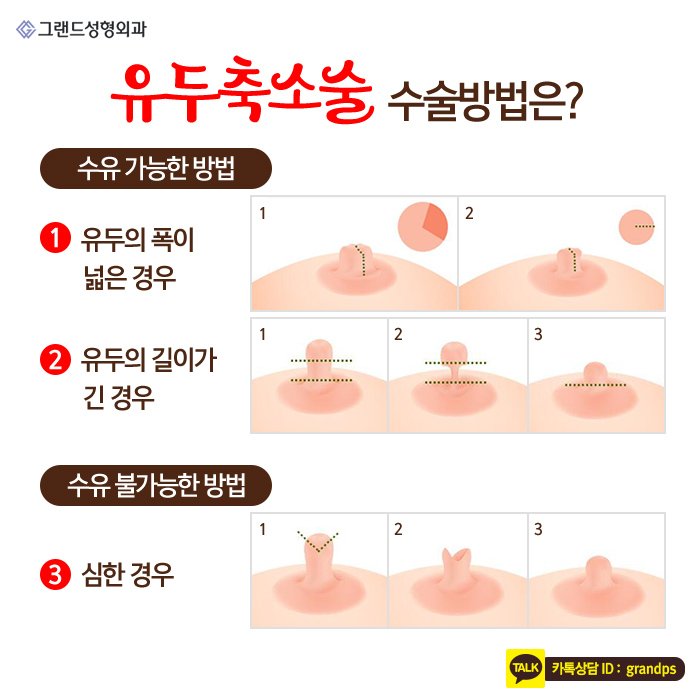 Grand_PS's tweet image. 유두비대증은 외관상 좋지 않을 뿐 아니라 스스로 자존감이 떨어져 일상생활을 하는데 있어 스트레스를 받는 경우가 있는데요. 정상적인 생활이 어려울 정도로 스트레스를 받는다면 그랜드성형외과의 유두축소술이 도움이 될 수 있습니다! #그랜드성형외과
