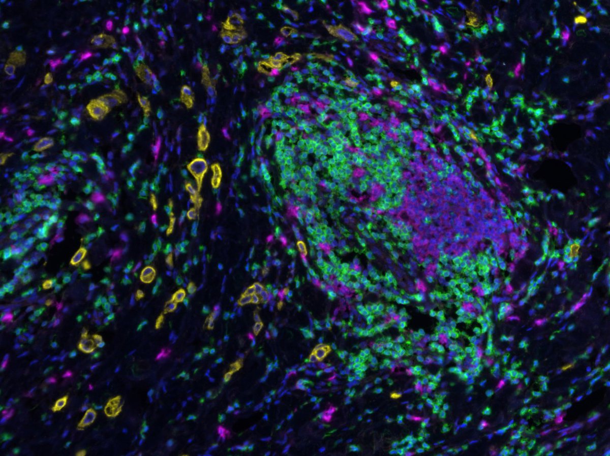 Tumor immunoprofiling: <a href="/HISTALIM/">HISTALIM</a> launches HISTOPROFILE  histalim.com/tumor-immunopr…  #AACR17 #MultiplexIHC #ImmunoOncology <a href="/AACR/">AACR</a> #AACR #AACR2017