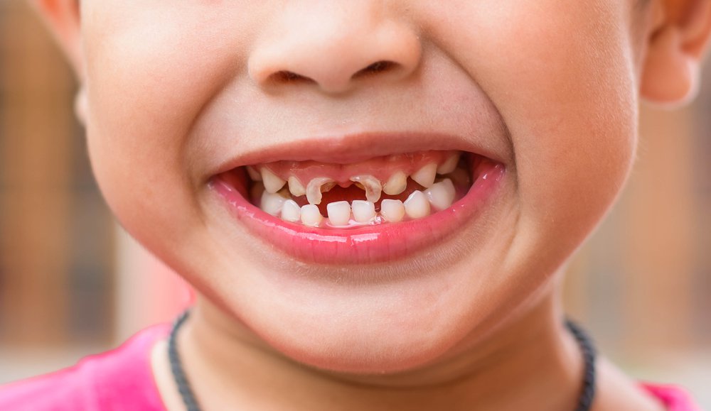 Government’s ‘lack of strategy’ on child tooth decay lambasted dentistry.co.uk/2017/04/03/lac…