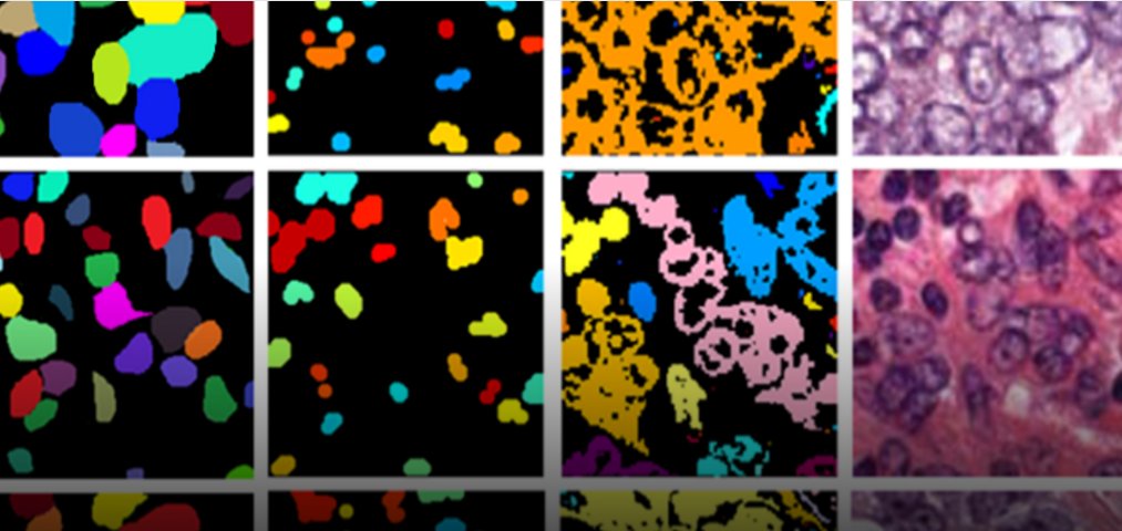 NVIDIAAI's tweet image. An #AI pathologist is leading to more accurate diagnosis and effective treatments for breast and prostate cancer: nvda.ws/2o2xdi9