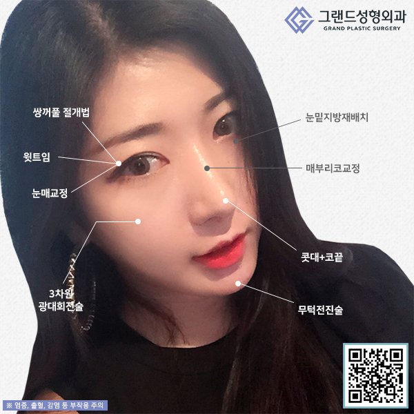 Grand_PS's tweet image. 눈밑 지방이 빈약한 부분으로 지방을 이동하여 지방과 다크서클을 동시에 개선할 수 있는 그랜드성형외과 눈밑지방재배치는 일반 지방보다 더 작은 지방을 이식하여 좀 더 섬세하고 정교한 시술이 가능하다는 장점이 있습니다. #그랜드성형외과 #눈밑지방재배치