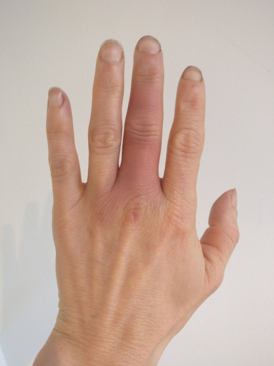 BexSimonArtist's tweet photo. Not sure what happened to my finger! Anyone anyone? #itdidnthurt #blacksmithproblems #freakyfinger https://t.co/JBtTjtP5tm