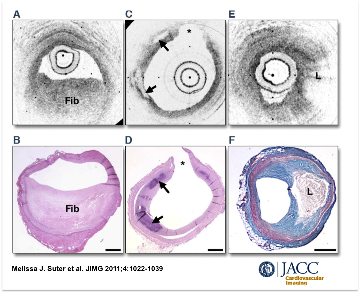 hect2701's tweet photo. #NoMatterTheColor B/W or Sepia #OCT: beautiful correlations with histology
@sbrugaletta @nicolasamabile @carlos__campos @CiticMexico https://t.co/j8WkYYQAGN