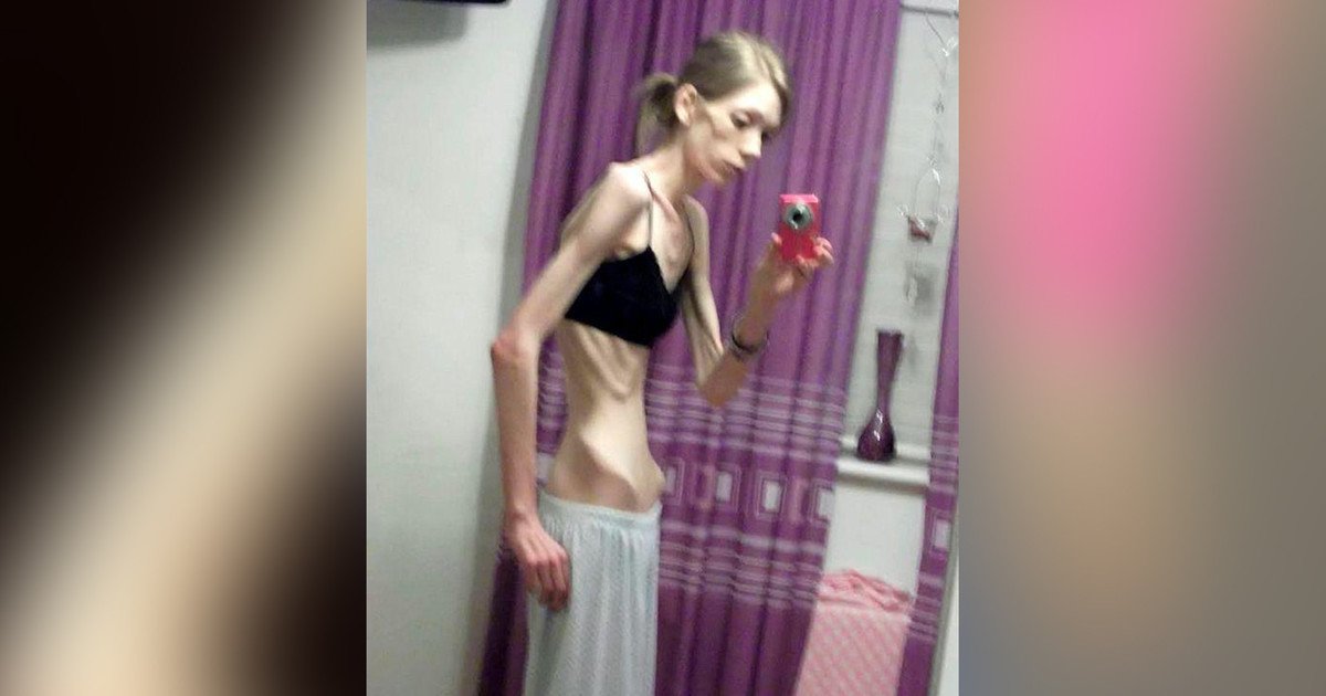 Anorexia centros de ayuda Anorexia centros de ayuda