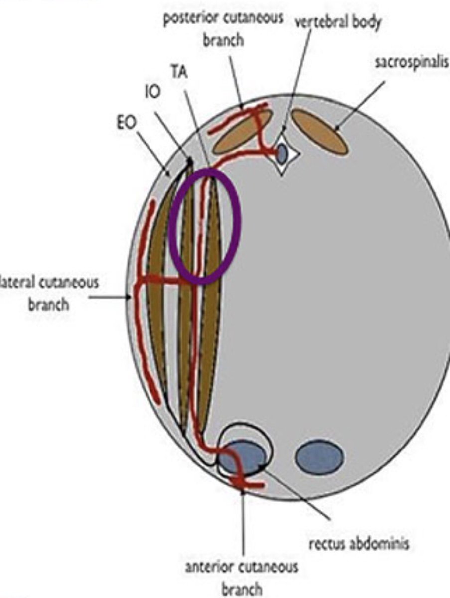 dr_tgro's tweet image. Forgot where 2 place ur #needle 4 a #TAPblock? #TAPit (b/w the iO and the tA) #TAPit @ASRA_Society @nelkassabany