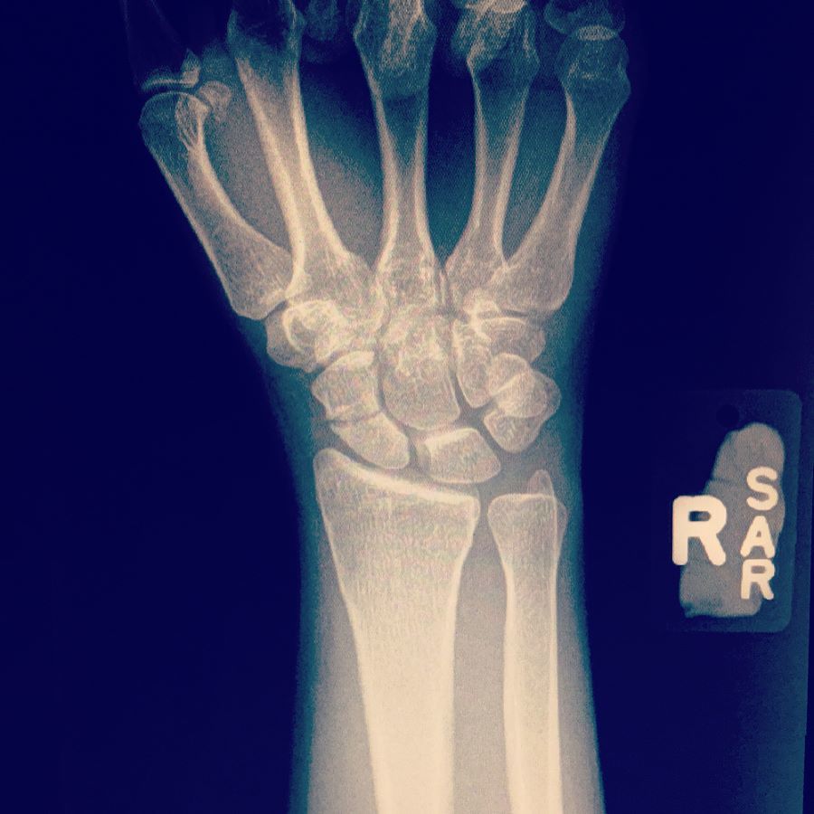 badashdesigns's tweet photo. The one instance where "Nashville" filter works. 🙈#brokenscaphoid #bikeaccident #ihadgravellodgedinmyskin https://t.co/GyD4wCwWms https://t.co/OdvbTL7ZzG