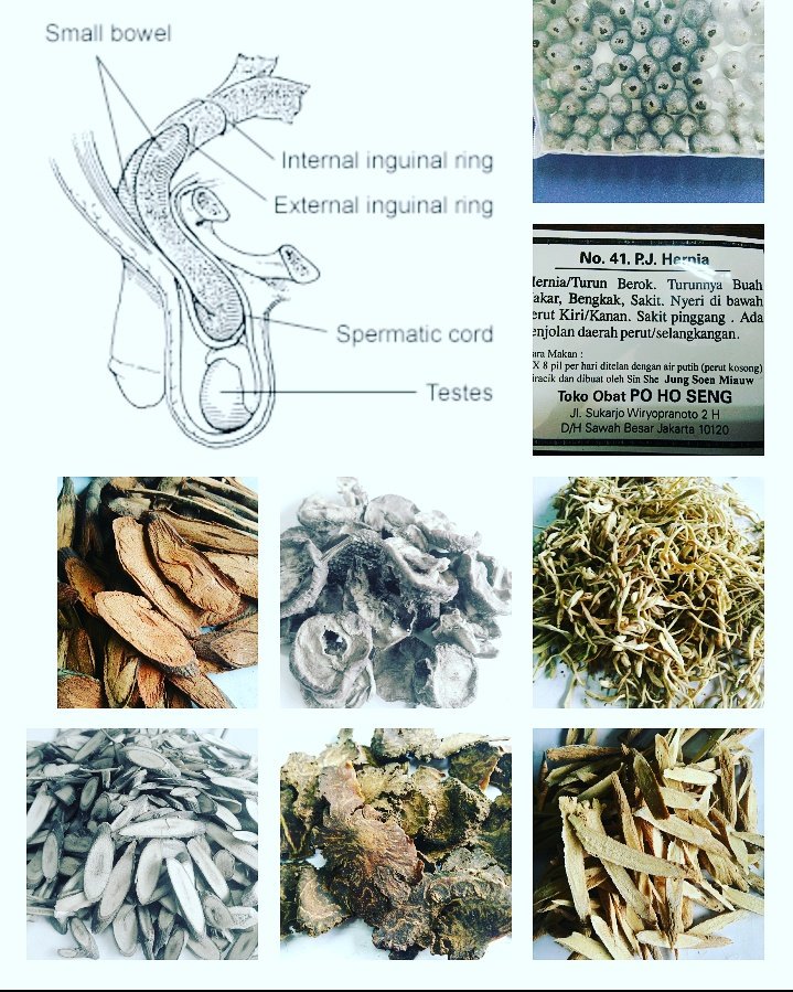 PoHoSeng's tweet photo. No: 41. Pil Jamu Hernia
#hernia #turun #berok #buah #zakar #bengkak
https://t.co/zVmqlpmFJ9
#PoHoSeng #保和生 #jamu #herbal #acupuncture https://t.co/vEodWBvzvO