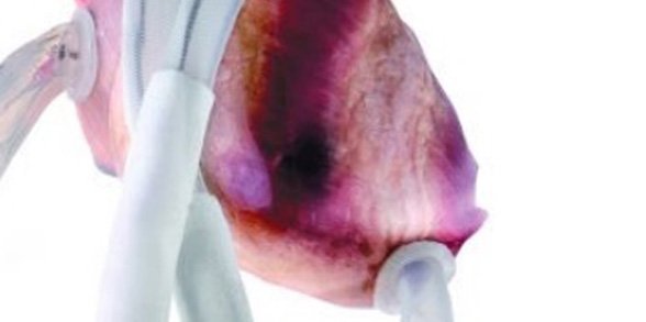 bambinogesu's tweet photo. Il "Berlin Heart EXCOR VAD" è il #cuoreartificiale più utilizzato in età pediatrica e infantile. Ecco come funziona➡️https://t.co/9jPuTF4Qmy https://t.co/uzlL4MpMDZ