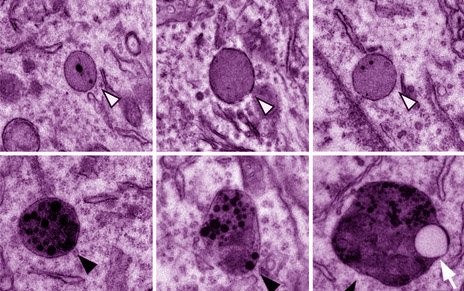 CSIC's tweet photo. Hallado uno de los mecanismos genéticos que desencadenan la degeneración neuronal en el #Alzheimer https://t.co/d8V8HvQXJv https://t.co/M6UapHQru7