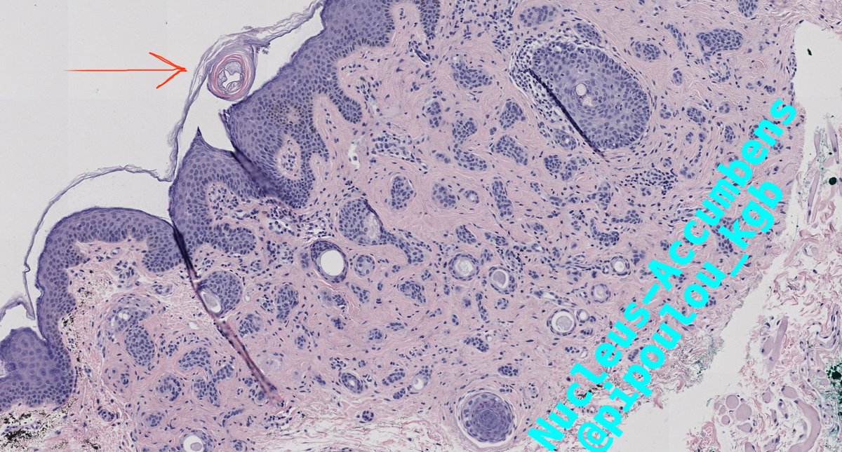 Have you ever seen a Demodex having a walk above a syringoma while all his family is sleeping under ? <a href="/JMGardnerMD/">Jerad Gardner, MD</a> @phmckee1948 <a href="/Lumpeyz/">Yuゆ</a>