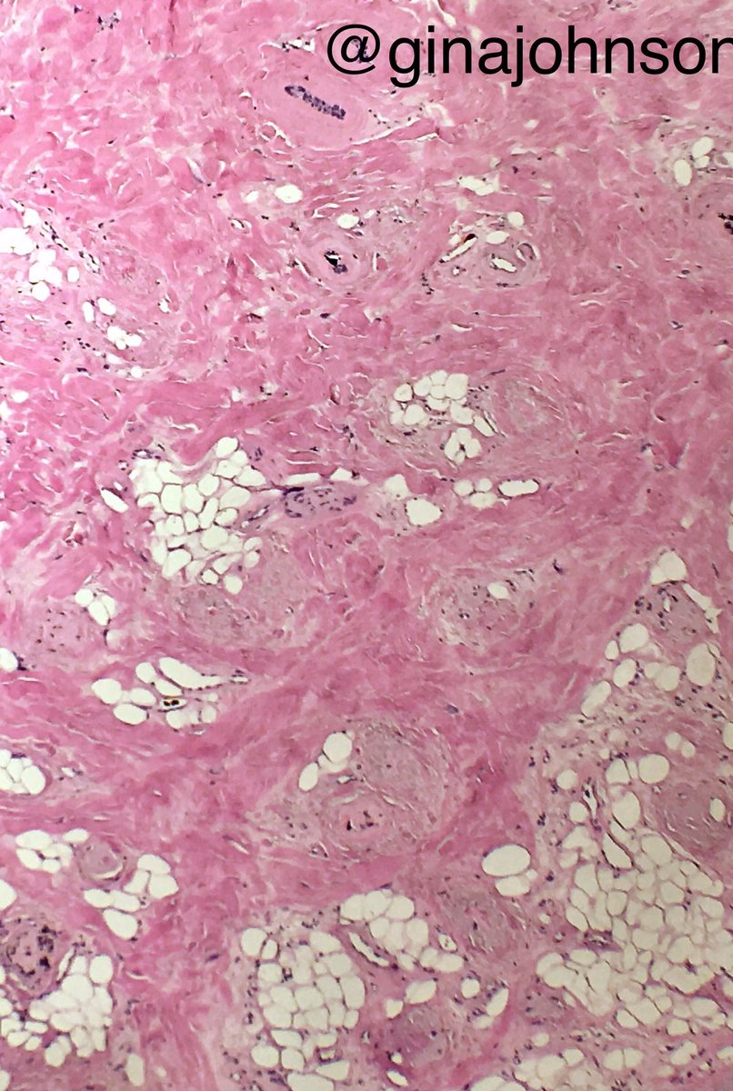 ginajohnsonmd's tweet image. Pop quiz: Alopecia bx. R/O metastatic breast ca. What&apos;s going on here, @LenSperling ?