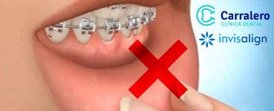 dentalcarralero's tweet photo. RT @Invisalign_xtv: Olvídate de las molestas llagas con la #ortodonciaInvisible #invisal...
https://t.co/gOcQ7CP4JP https://t.co/JZz6QCoIGe