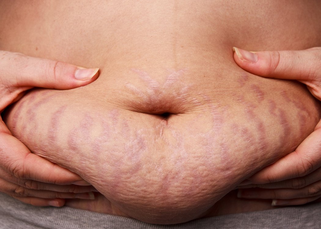 GreenicheTweets's tweet photo. RT @EatThisNotThat Have #stretchmarks? Here's how to banish them: https://t.co/XgBHcTYoXe
#Skincare
@WomensHealthMag
https://t.co/81J2rlau3U