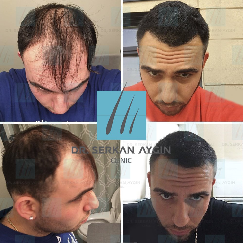Dr Serkan Aygin On Twitter How Can A Hairtransplant Change