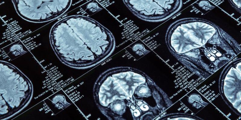 TACC's tweet photo. Novel Algorithm Could Help Predict Depression Diagnoses @RandDMagazine https://t.co/hyaBr7wxEC https://t.co/tVz18CGPHu