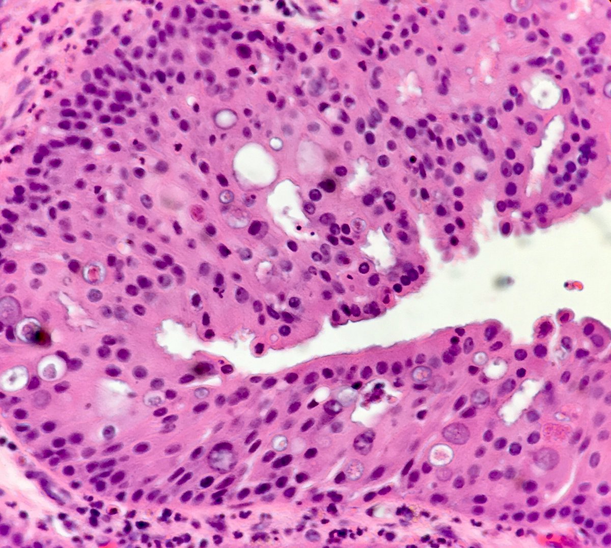 Oncocytic inverted papilloma - Oncocytic papilloma nasal cavity