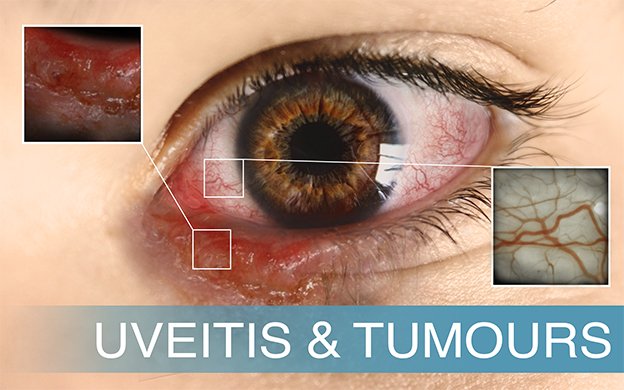 EyeVue1's tweet photo. Optical Coherence Tomography Angiography Allows for Early Detection of Radiation Maculopathy https://t.co/9LGGjYrxoN https://t.co/bzOJWYWbFM