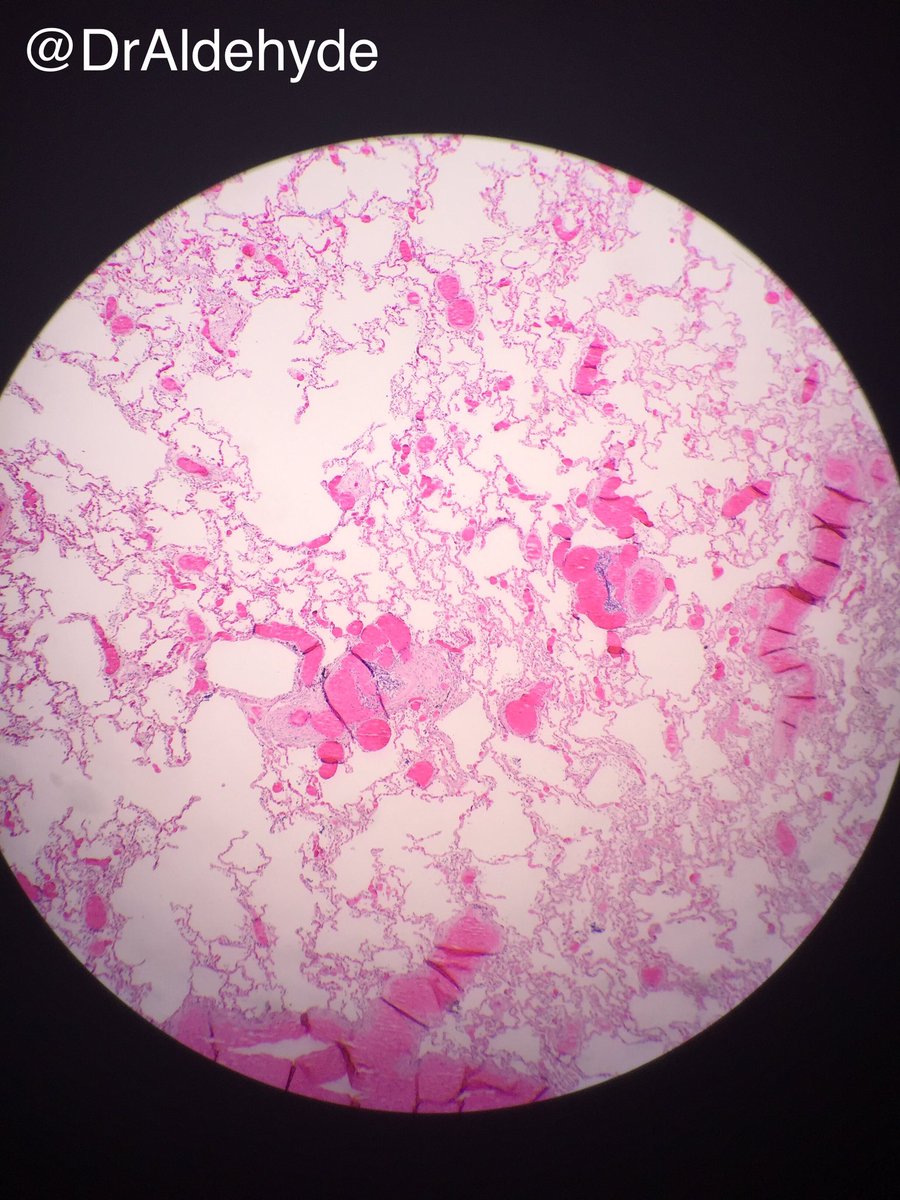 DrAldehyde's tweet photo. Pulmonary arterial hypertension secondary to Eisenmenger's complex showing plexiform lesions. #pathology #eisenmenger #autopsy #lungpath https://t.co/ctebubKldO