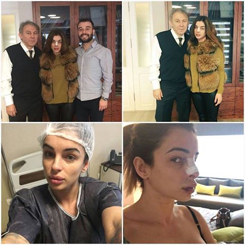 surgerytr_'s tweet photo. Our patient got her lip reduction and rhinoplasty operation with us. She is so happy about the result. #SurgeryTR #nose #nosejob https://t.co/AA9rmlJWdF