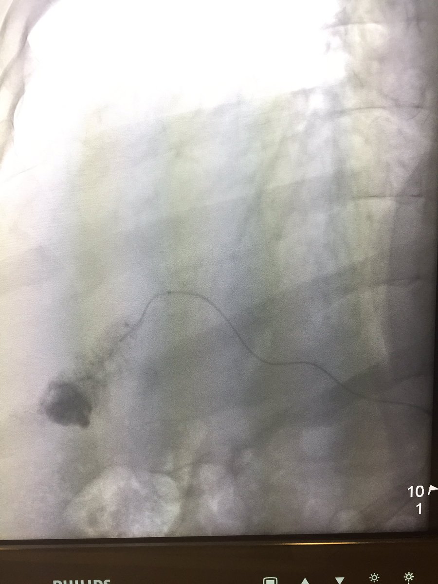 mb_Oncology's tweet photo. Rahul Patel: LIVE @MountSinaiIR #superselective #transradial C-TACE. Love the #stain @JVIRmediaโฆ https://t.co/KC5ElO4DvI #MedicBoard https://t.co/P8i7p258WL