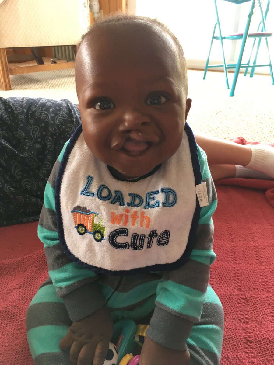 Babies are arriving for life changing surgery