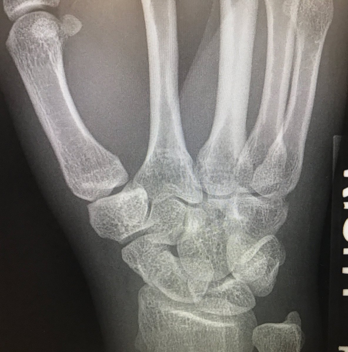 60SecMedEd's tweet photo. Anyone see a fracture? 

#FOAMed https://t.co/AMYnY4ur3n
