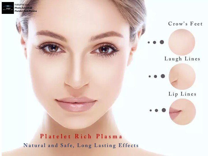 helloprp's tweet image. Hello PRP Therapy
#plateletrichplasma
Skin Rejuvenation
"The Obvious Choice For Aging Skin"
HelloPRP.com