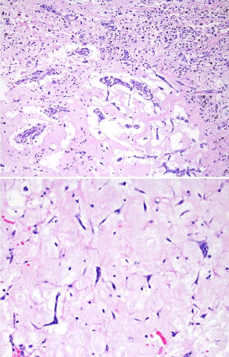 65-year-old man with a left atrial mass.... Diagnosis? What syndrome can this be seen in?  scvp.net/com/ucom16.html #cardiacpath <a href="/_SaranyaS_/">Saranya Singaravel</a>