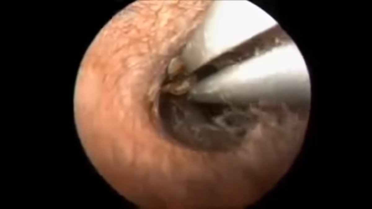 digitaljunkfeed's tweet photo. MAN HAS 26 COCKROACHES IN HIS EAR. REMOVED.
#funny #weird #Science #VIDEO

https://t.co/5aDP4Eu4NE https://t.co/brJw6iXUuq