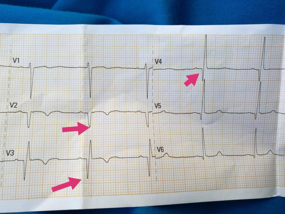 urgenciasemerge's tweet photo. #Ekgtips del mes: onda Q patológica si >0.04 s de ancho o más de un 25% de profundidad de la onda R. Tb si presente de V1 a V3. #ECGtips https://t.co/bhnMSxjwTi