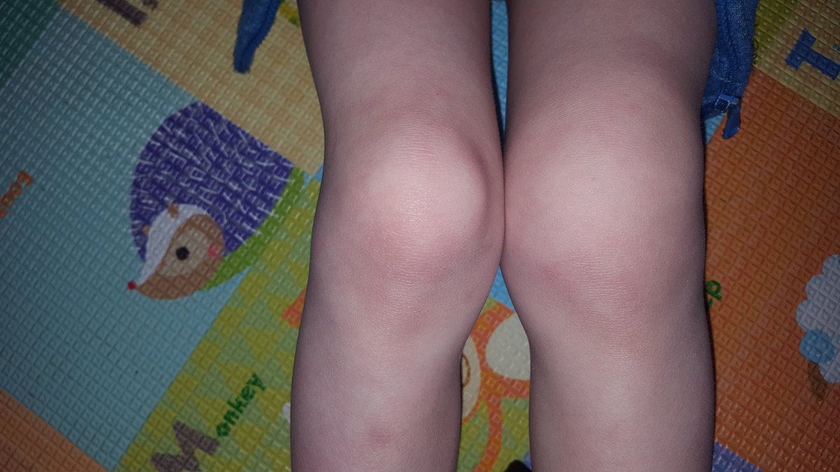 TeamSuperP's tweet photo. My poor girl... #kidsgetarthritistoo #SuperP #JAwarrior #shesmyhero https://t.co/fecVwCsORo