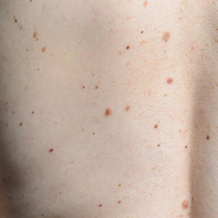 PreventionMag's tweet photo. 8 skin issues that could signal something bigger's going on: https://t.co/kRDucHUrWt https://t.co/tJIudufy5v