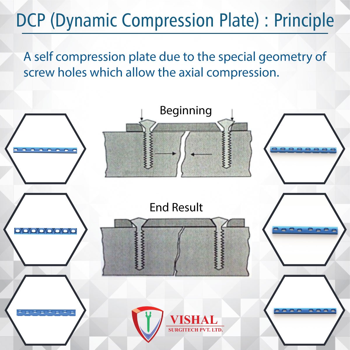 X-এ Vishal surgitech: DCP (Dynamic Compression Plate) Principle  #VishalSurgitech #DCP #Principle #SelfCompression #ScrewHoles  #AxialCompression  / X