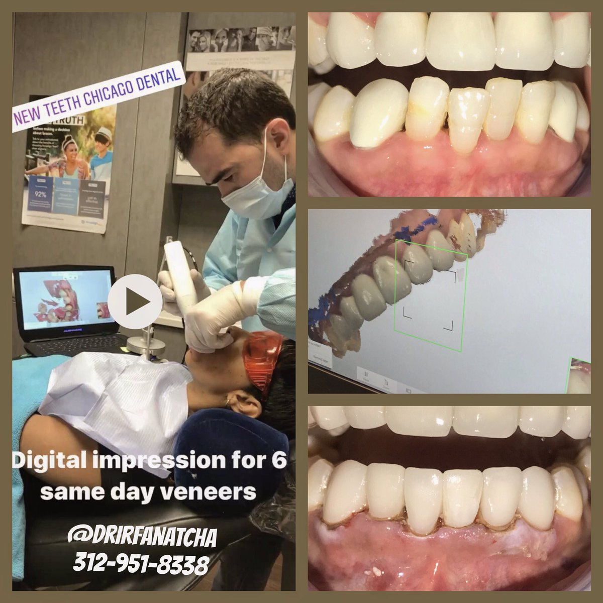 Newteethglobal's tweet image. Same day #porcleinveneers #digitalimpression #cosmeticdentistry #chicago 312-951-8338 lower 6 frnt teeth @Newteethdental