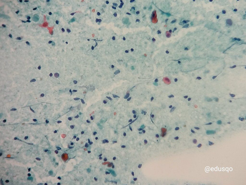 edusqo's tweet photo. #FNAFriday Diagnostic #Pitfalls in #Warthin tumor on Fine Needle Aspiration #Cytology squamous metaplasia w dyskeratotic cells vs metastasis https://t.co/0yf7gsDFwt