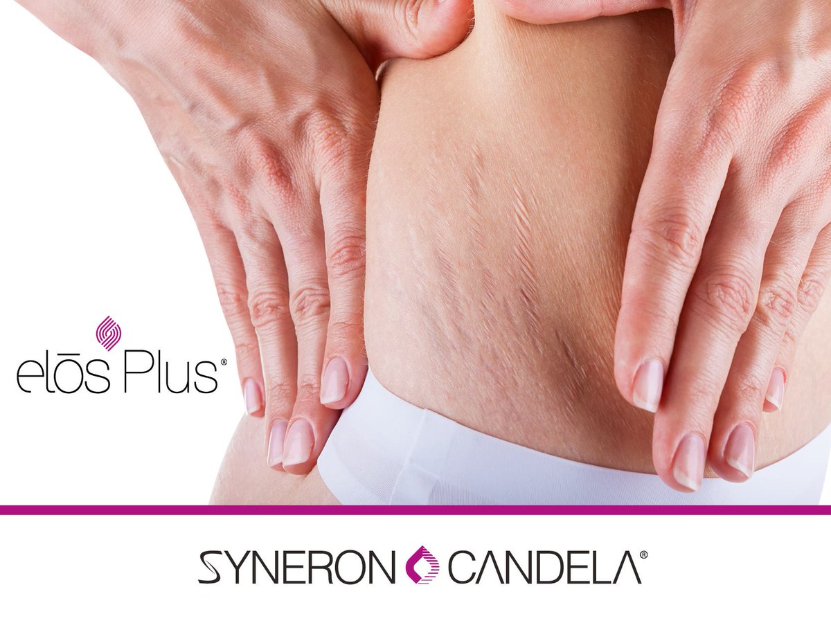 CandelaFrance's tweet photo. RDV au Congrès AMME du 04 au 06 Mai 2017 à Arcachon ! Participez à nos traitements en live ! #ElosPlus https://t.co/x7dBfaI8yB