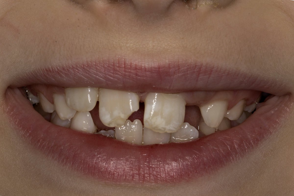 DMDGroup's tweet photo. Celebration of Excellence Month Dr. Sadineni AACD Case Tooth Bonding
#ToothBonding #DMDSmiles #SmilesByDMD #DMDpatients https://t.co/Y73xfSlREE