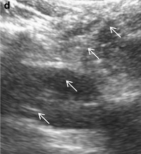 Online now:
Everything u need 2 know about #ultrasound guided peds lumbar puncture
ow.ly/loOe30avn1x
#PedsRad <a href="/The_ASPNR/">American Society of Pediatric Neuroradiology</a> <a href="/socpedsir/">SPIR</a>