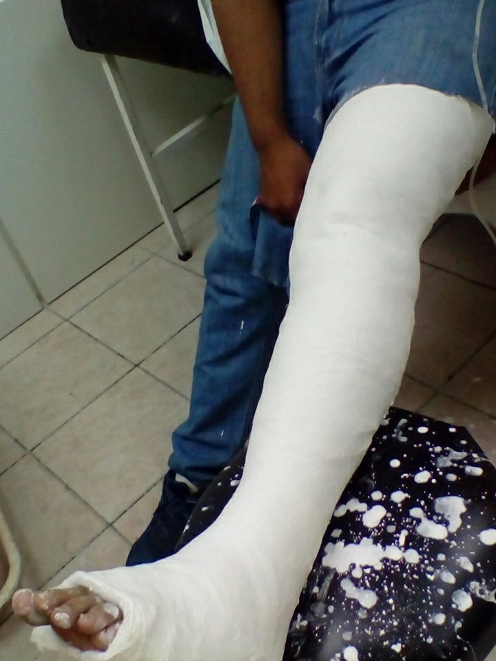 pamelatoledo28's tweet photo. Así quedo @rcamachovzla luego de la fractura a que sufrió #10Abr producto de una bomba lacrimógena https://t.co/SBrFWwmoh6