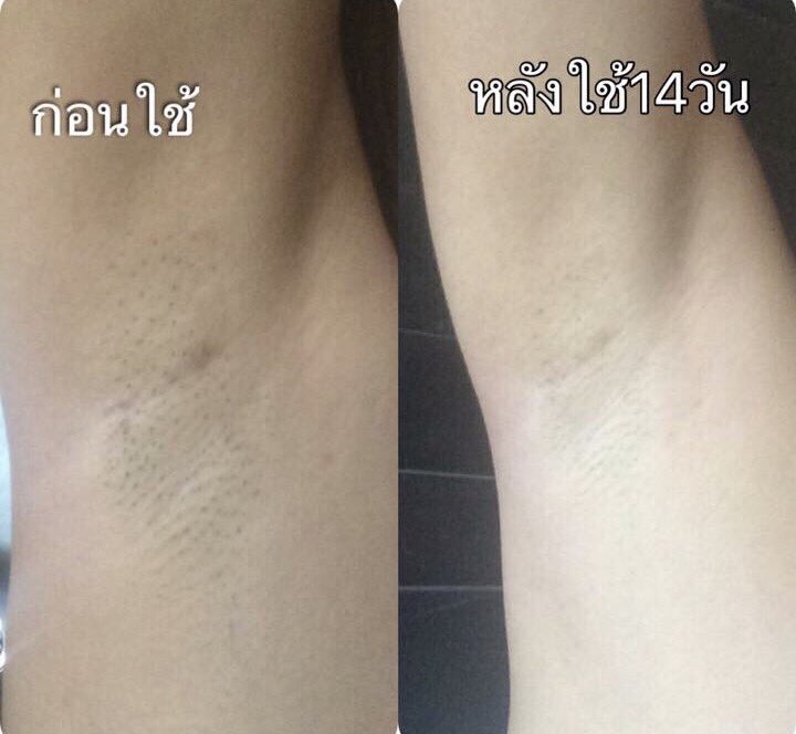 maxaz17's tweet photo. #howtoperfect บอกเลยว่า รักแร้ขาว 100% ไม่มโน ไม่ตอแหลเลย ครีม AUTY คือ เห็นผลจริง ชอบมากกก มั่นใจ รักแร้ไม่ดำ 10/10 #ฉันจะสวย https://t.co/Ef5xpkh3Fk