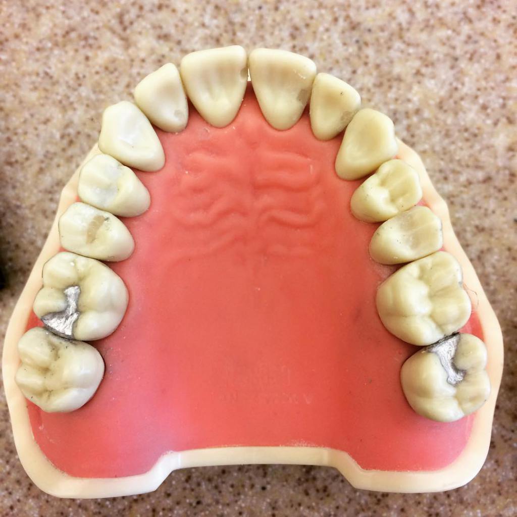 retrotechinfo's tweet photo. Class II Amalgam restoration #3DO and #15MO… https://t.co/GgZ7andHdF https://t.co/VkvJYE8rxz