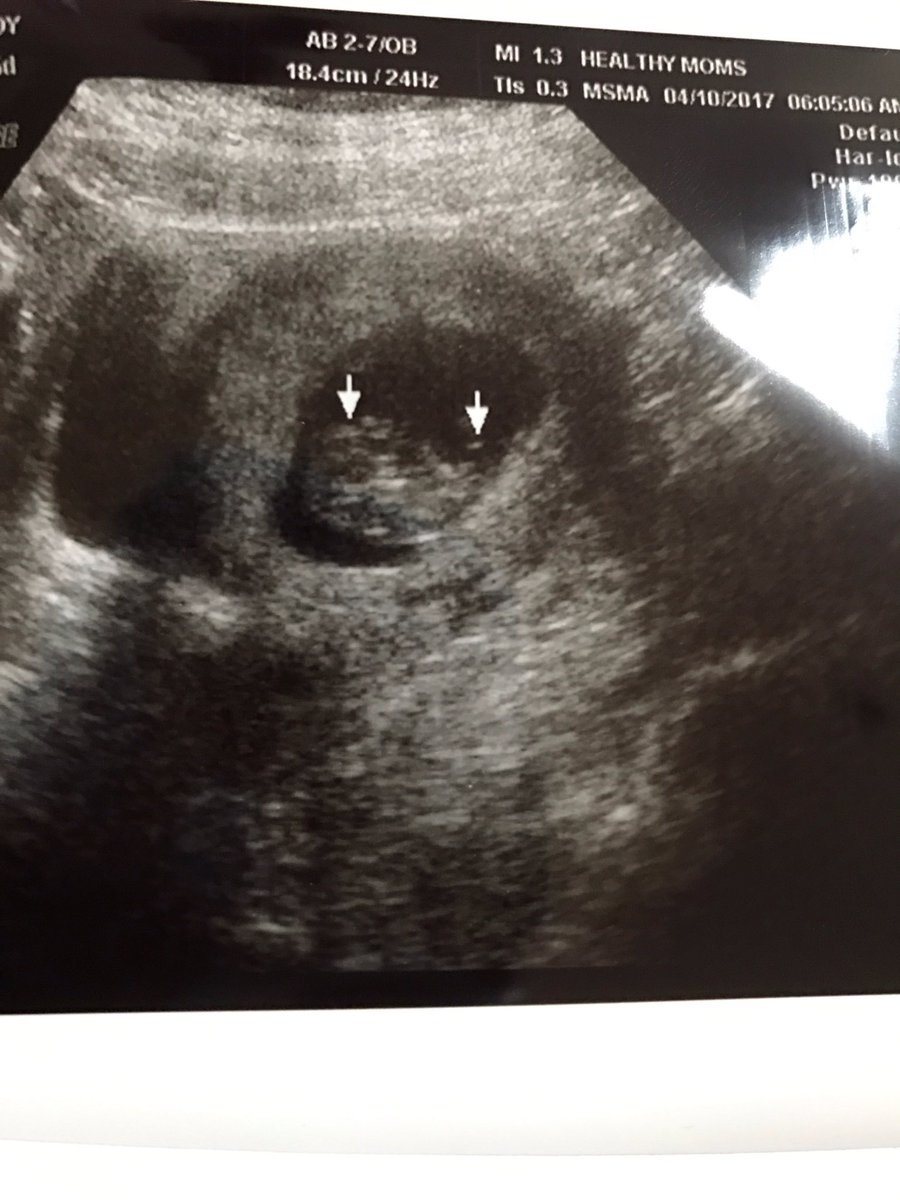 KassidyVarnell's tweet photo. Thats my niece/nephew right there 😍 #promotedtoAUNT #teampink https://t.co/oNo4lOWeig