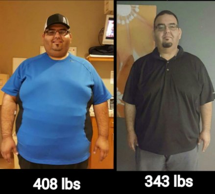 RioSurgical's tweet photo. #TuesdayTransformation: Left-12/23/16. Right-3/24/17. Look at the amazing transformation in just 3 months! Keep up the great work Johnny! https://t.co/wMhecdRQHs