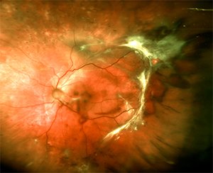Harvard Ophthalmology faculty identify new therapeutic target for retinal neovascularization in diabetic retinopathy bit.ly/2o6qgcX