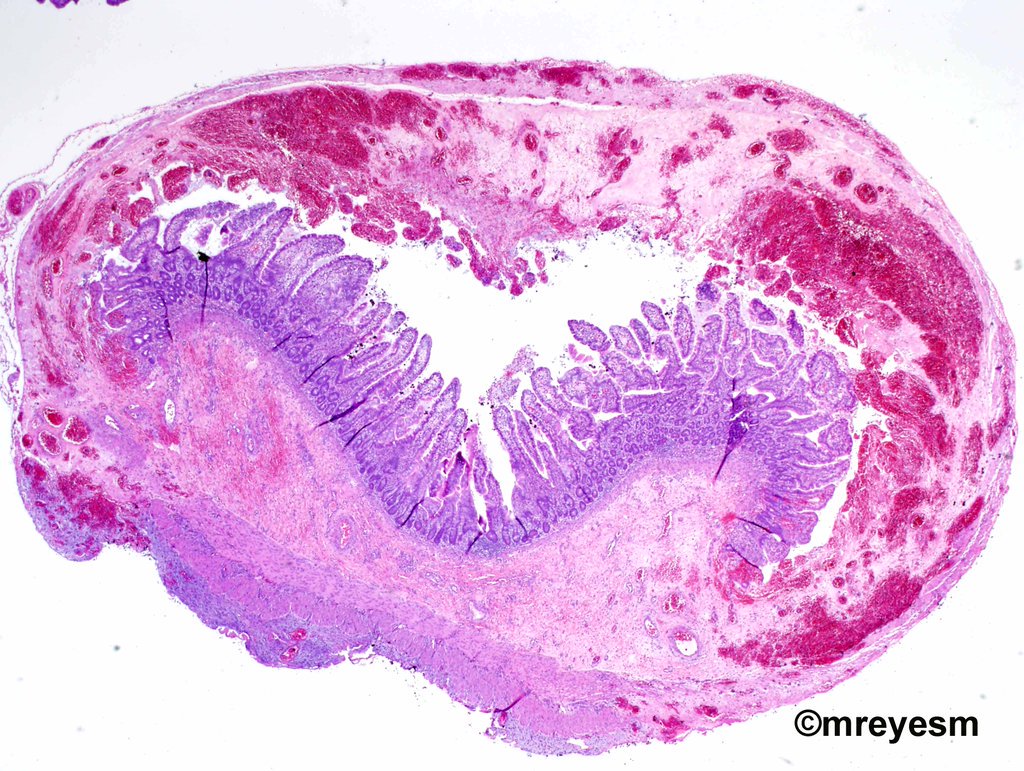 SocPediPath's tweet photo. RT @mreyesm: Necrotizing enterocolitis. Disease of prematurity. #PediPath @IslandJewelsena @marenwhymd @hematogones https://t.co/mDUiC2bZae