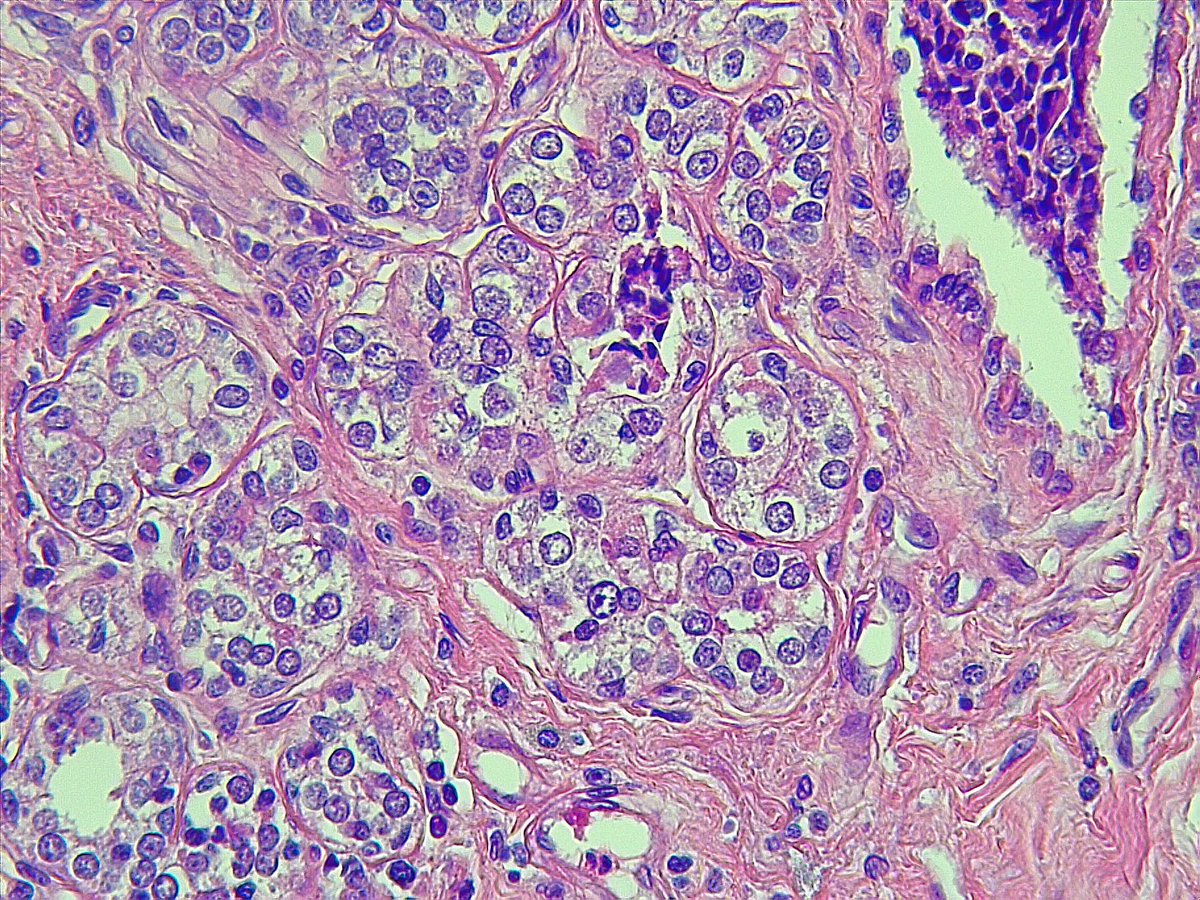 DrAlessandroIac's tweet photo. #AcinicCell #Carcinoma of the #Breast. Cell with granular cytoplasm and sometimes #ClearCells. #BreastPath #pathology #breastcancer https://t.co/x8w4P8Xw9r